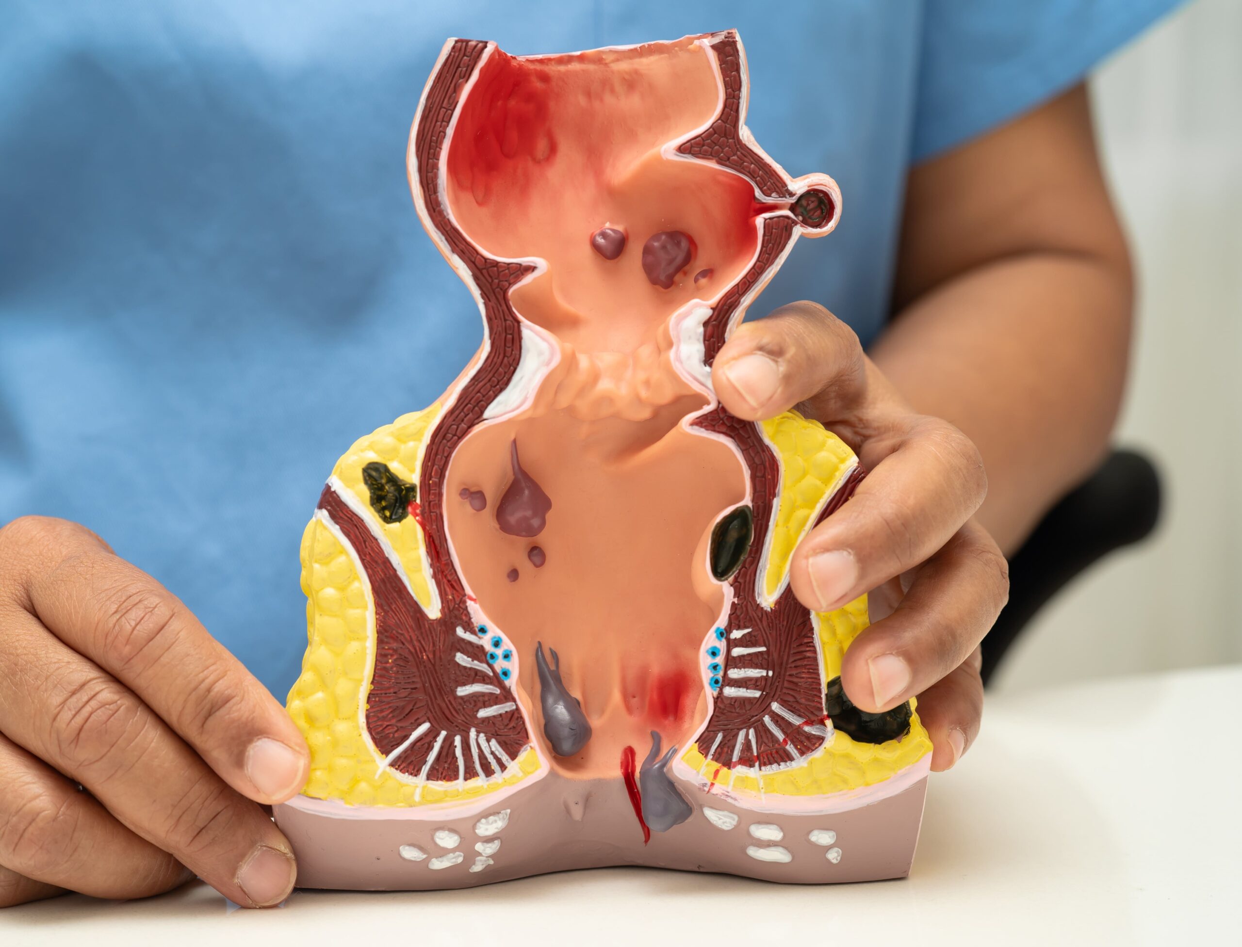 Anal fistula — tunnel between anus and skin
